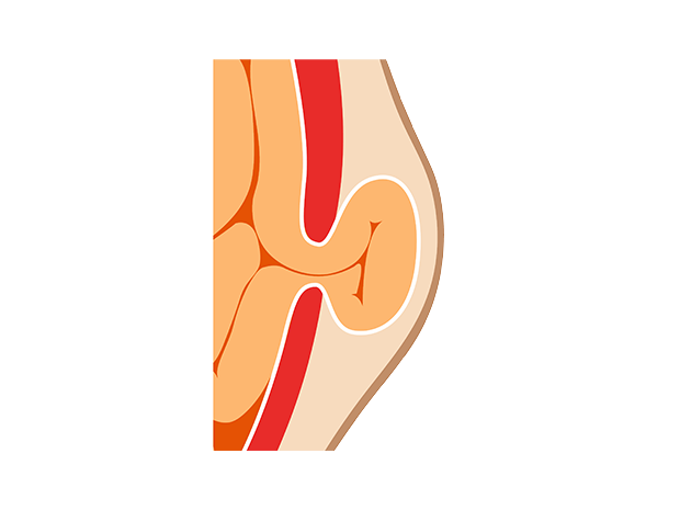 Hernia Bulge Illustration