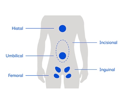 Hernia Type Locations