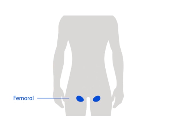 Diagram of a person highlighting upper thigh area showing femoral hernia location