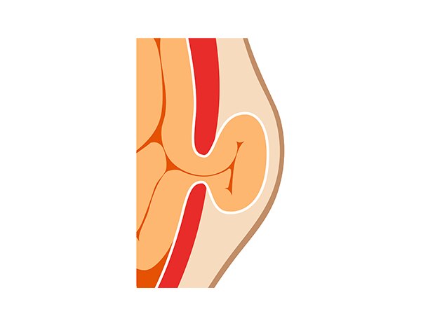 Illustration showing the intestines protruding through weakened spot in abdomen to create a hernia