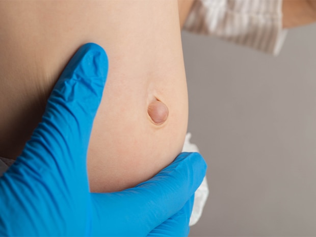 Gloved doctor showing infant with umbilical hernia