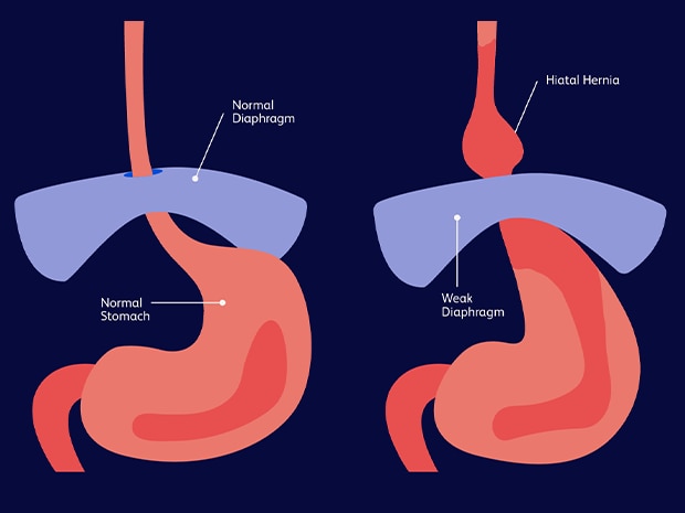 Diagram of a weak diaphragm forming a hiatal hernia