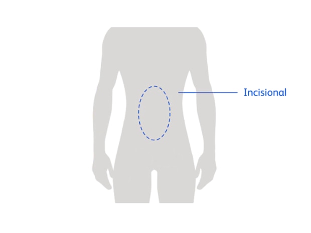 Diagram of a person highlighting abdomen area showing common incisonal hernia location