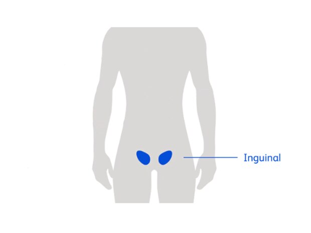 Inguinal Hernia Diagram