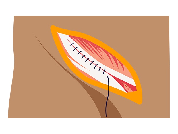 Illustration of an inguinal hernia repair stitched up