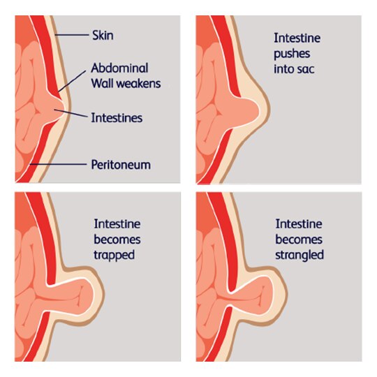 Timeline of how a strangulated hernia forms