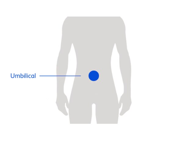 Umbilical Hernia Diagram