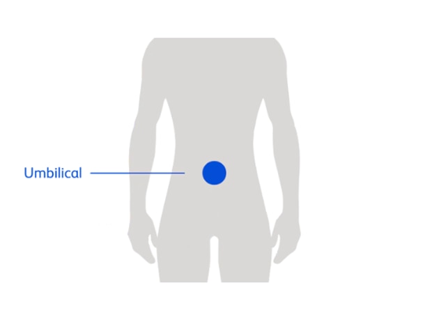 Diagram of a person highlighting belly button area showing inguinal hernia location