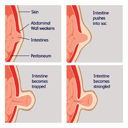 Strangulated Hernia Diagram