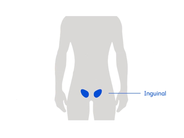 Ventral Hernia