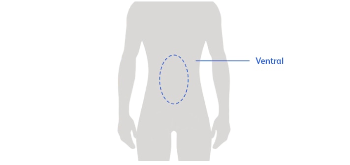 Ventral Hernia