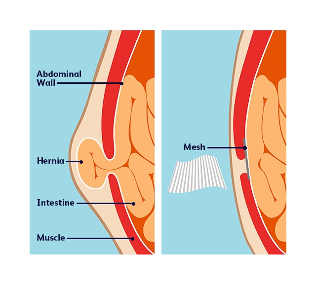 Hernia Mesh Diagram