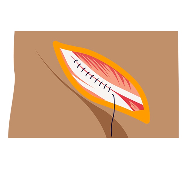 Hernia Mesh Diagram